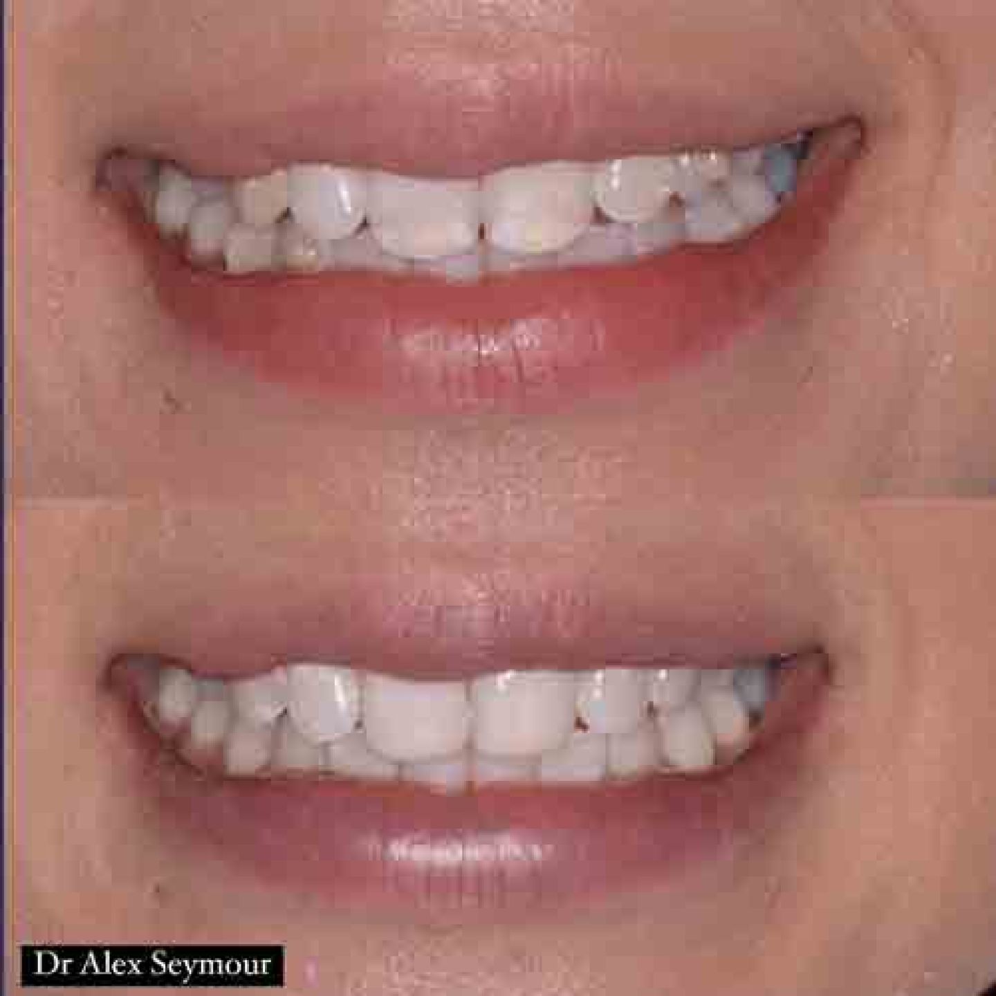 Composite Bonding Gallery Composite Bonding Gallery